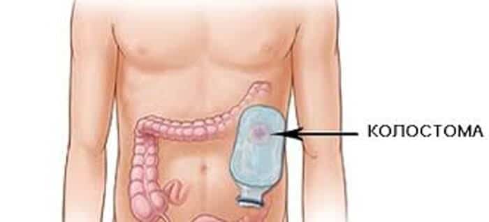 Колостома. Колостома сигмовидной. Стомы кишечника колостома. Колостома на брюшной полости.